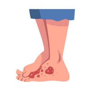 Diabetic wound problem result