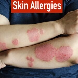 SKIN ALLERGIES RESULT