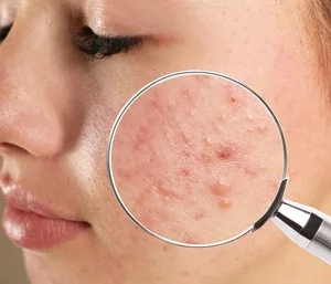 Pimples Problem Result